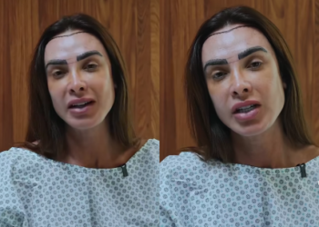 Nicole Bahls realiza transplante capilar para diminuir a testa: “Vou ficar feliz e cabeluda”